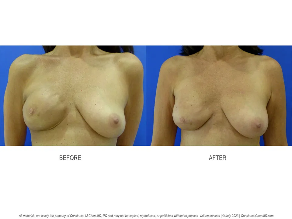 Real patient before and after photo Breast Reconstruction with Saline Implants #3